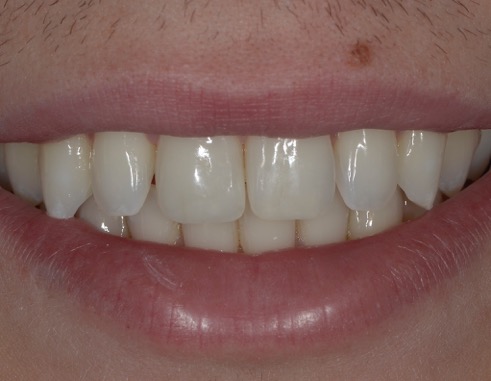 Résultat post-opératoire du Dr Serfaty avec composite Essentia 2 couches de chez GC et le polissoir Kenda Maximus Post-op après la passage du polissoir unique KENDA Maximus