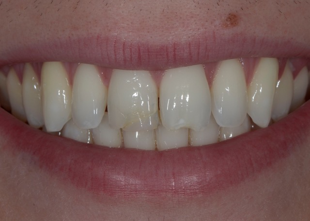 Cas pré-opératoire Dr Serfaty avec composite Essentia 2 couches de chez GC et le polissoir Kenda Maximus Cas pré-opératoire